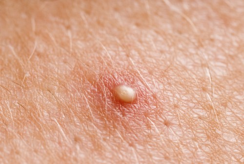 Whitehead-zit
